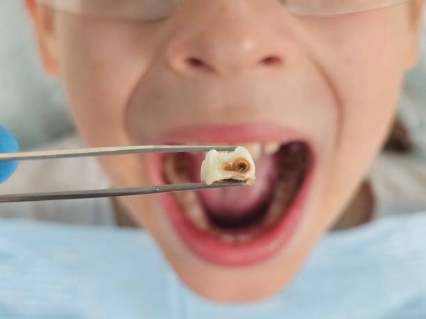 Best Broken or Chipped Tooth Repair in Panama City, FL